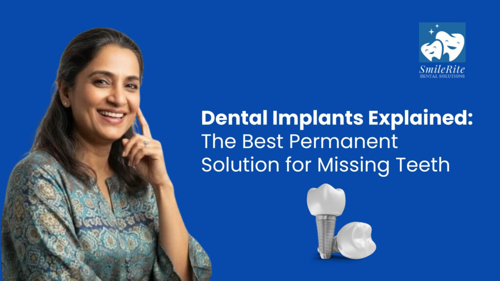 Dental Implants Explained: The Best Permanent Solution for Missing Teeth